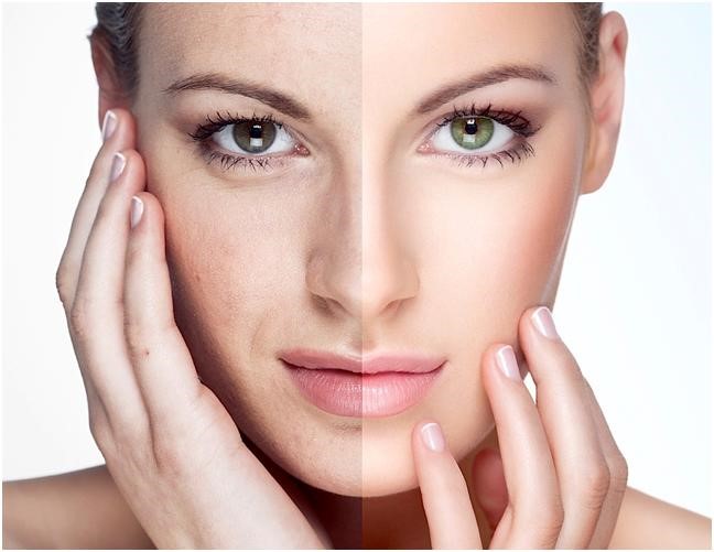 trước và sau khi sử dụng kem dưỡng trẻ hóa da ngừa mụn OBAGI 360 retinol